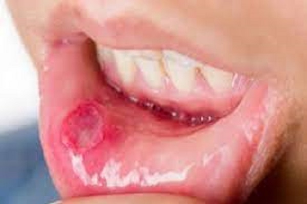 வாய்ப்புண்ணால் பெரும் அவஸ்தையா?!...  இதனை போக்க இதோ டிப்ஸ்!