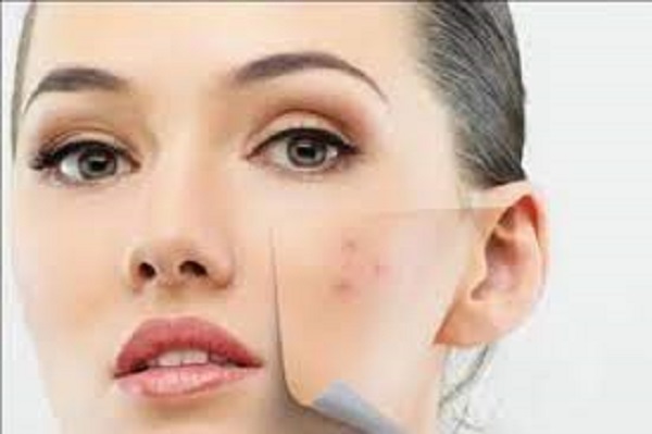 முகப்பரு, வீக்கம் போன்றவற்றை எளியமுறையில் போக்கனுமா?