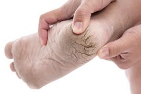 குதிக்கால் வெடிப்பா? இதனை சரி செய்ய வேண்டுமா?!