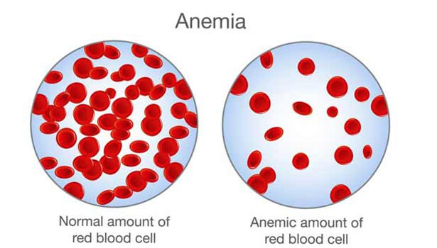 ரத்த சோகை அறிகுறிகளும் தடுக்கும் வழிமுறைகளும்... !!