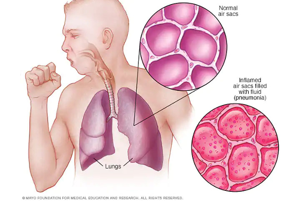 நிமோனியா என்பது என்ன?