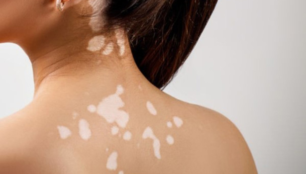 வெண் புள்ளியிலிருந்து விடுதலை தரும் வைத்தியம்