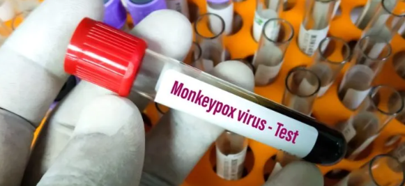Monkeypox தொற்றாளர்களின் பரிசோதனைகள் நாளை முதல் ஆரம்பம்