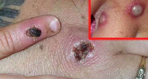 குரங்கு அம்மை தொற்றுக்கு முகங்கொடுக்கத் தயார்..!!