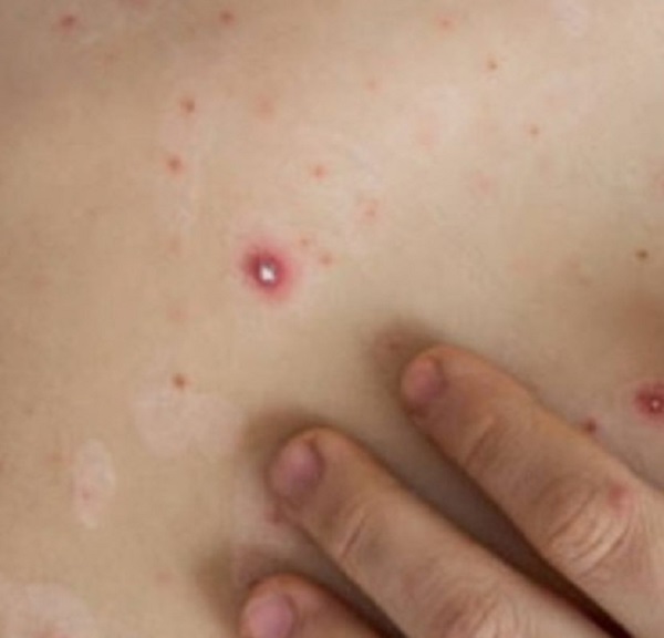 உலகளாவிய ரீதியில் கொரோனா,குரங்கு அம்மையை அடுத்து பரவும் தக்காளி காய்ச்சல்