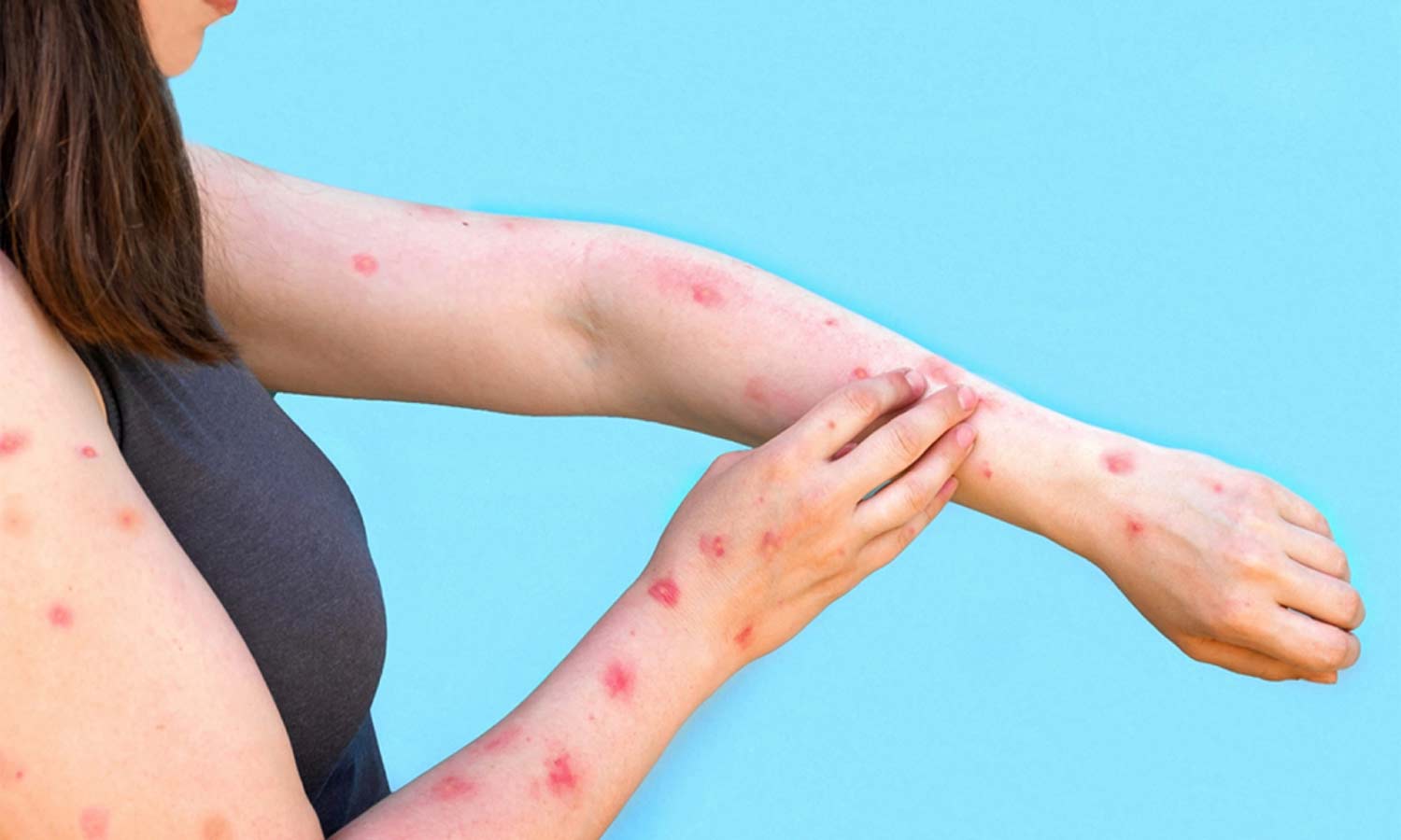 குரங்கு அம்மை: தெரிந்து கொள்ள வேண்டிய 8 விஷயங்கள்...