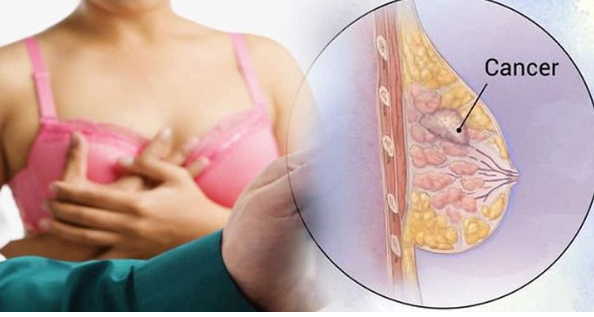 இந்தியாவில் 18 சதவீத பெண்களுக்கு மார்பக புற்றுநோய் பாதிப்பு..!!