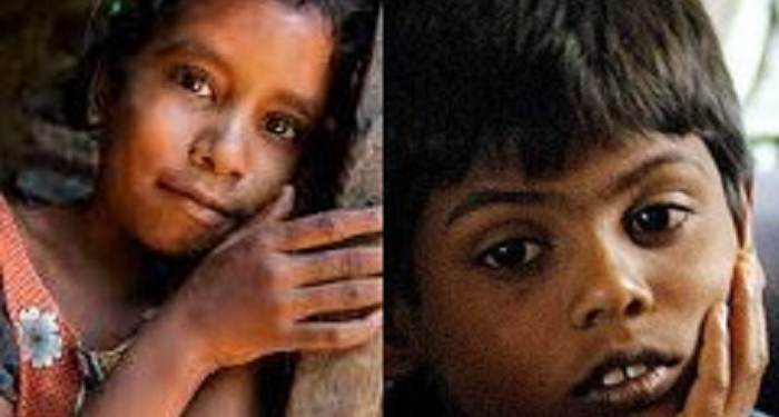 56,000 குழந்தைகள் ஊட்டச்சத்து குறைபாட்டால் பாதிப்பு -யுனிசெப்