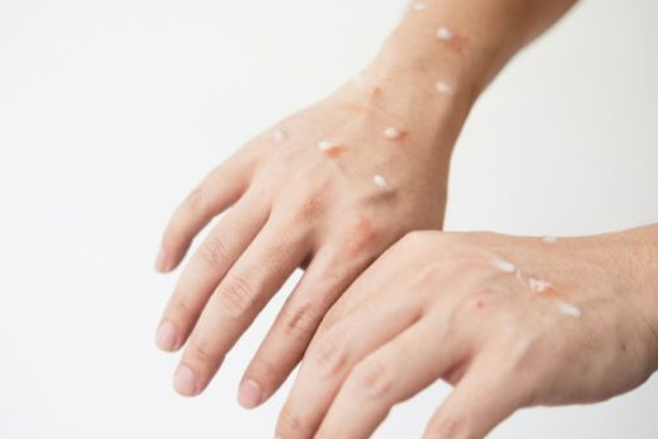 குரங்கு அம்மை தொற்றினால் கர்ப்பிணி பெண்களுக்கு கருக்கலைப்பு ஏற்படலாமென எச்சரிக்கை