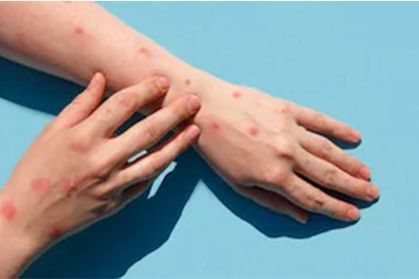 குரங்கம்மை பெயர் மாற்றம் தொடர்பில் வெளியான தகவல்