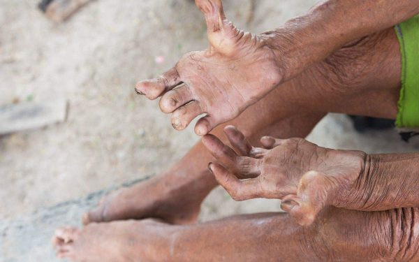 இலங்கையில் தொழுநோயாளிகளில் எண்ணிக்கை அதிகரிப்பு!