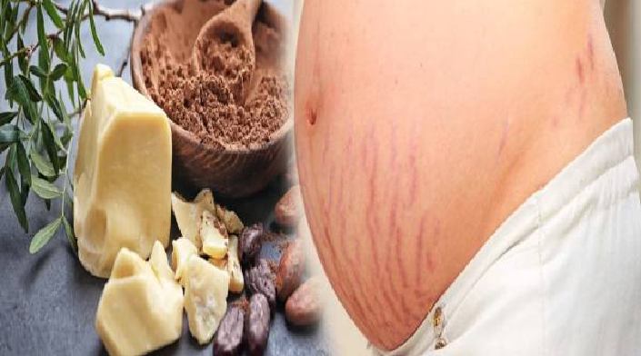 கர்ப்ப கால தழும்புகளை போக்கணுமா? அப்போ கோகோ பட்டர் தான் சிறந்த தெரிவு