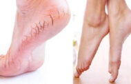 பாதங்களில் வெடிப்பு இருக்கா? அப்போ இதை செய்தால் போதும்