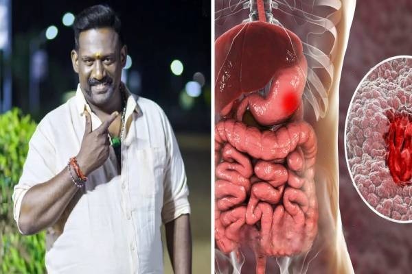 ரோபோ சங்கர் உயிரை காவு வாங்கிய நோய்.. அறிகுறிகளும், பாதிப்புகளும்